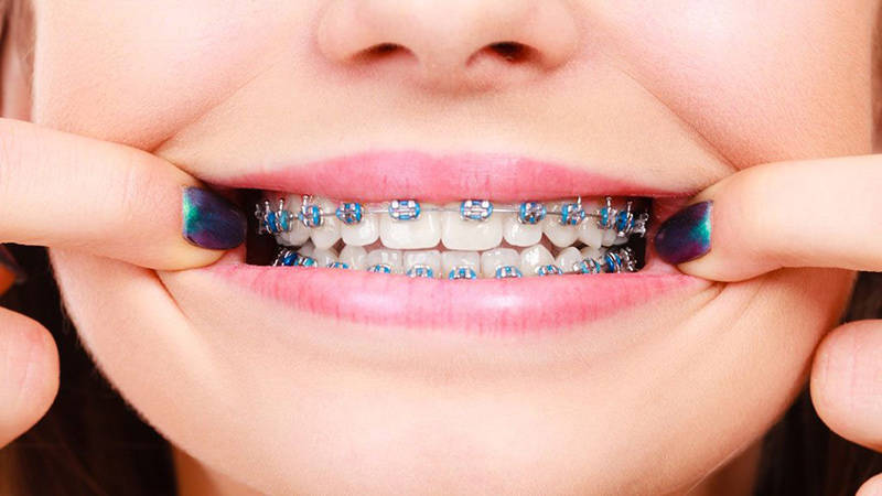 niềng răng mắc cài