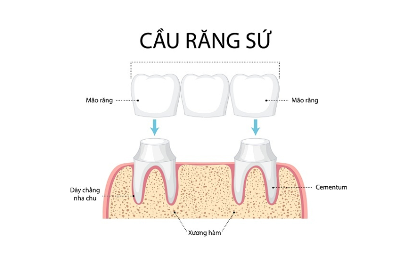 cầu răng sứ