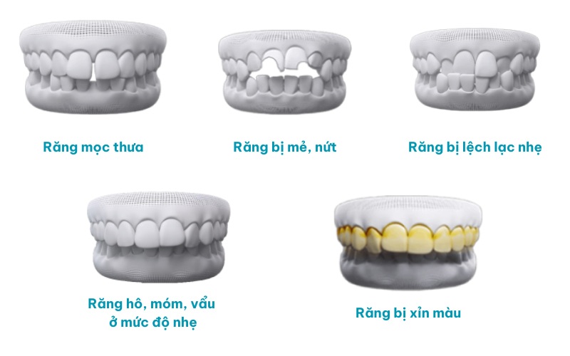 dán sứ veneer
