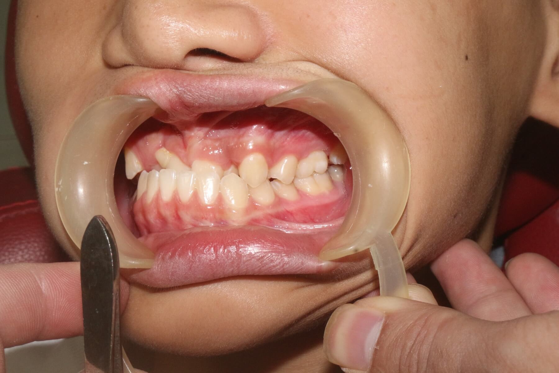 niềng răng trẻ em