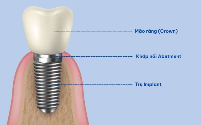 trồng răng implant